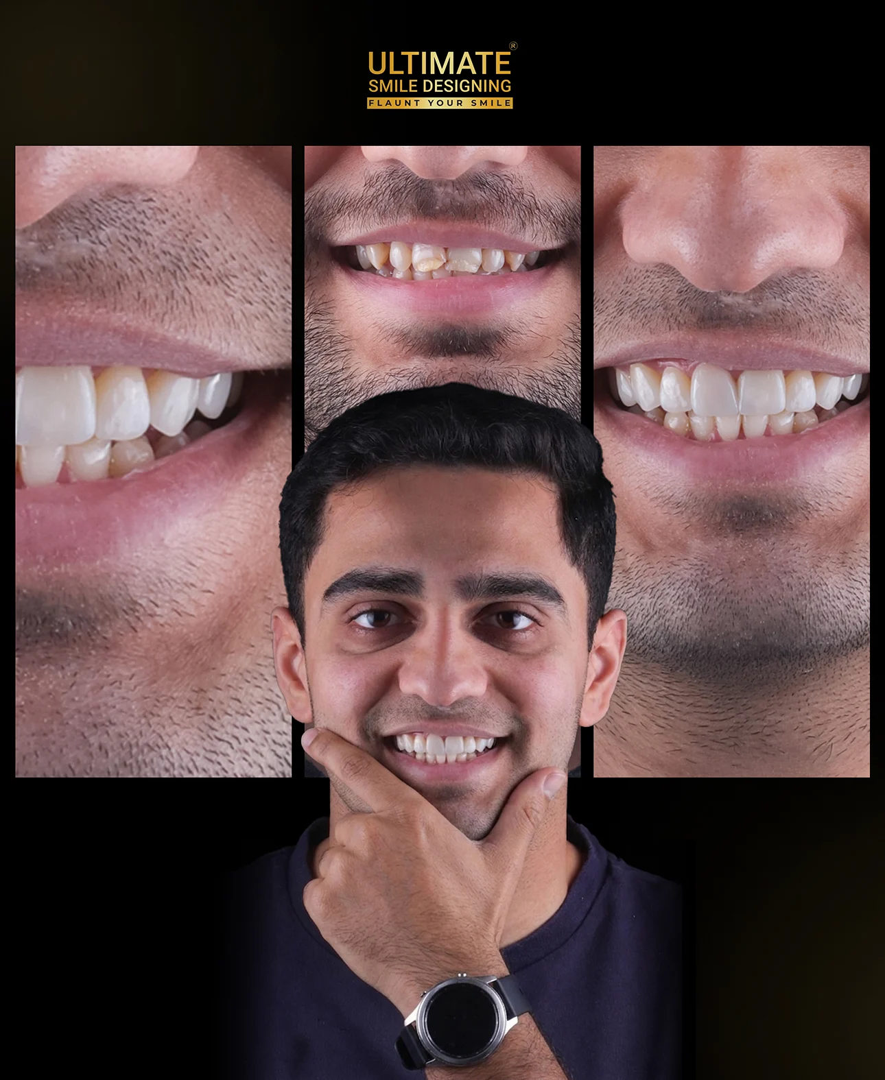 Dental veneers treatment before and after – enhanced smile aesthetics