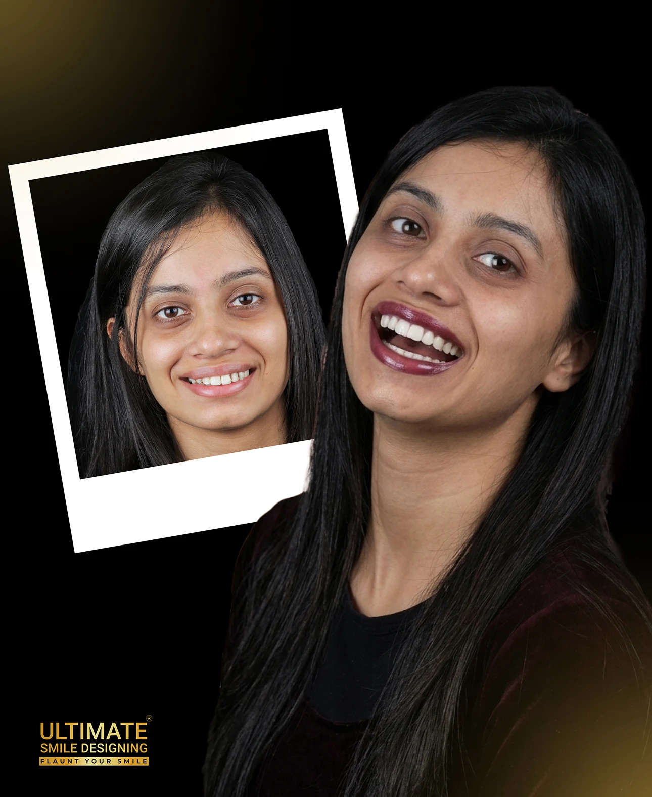 Natural smile enhancement before and after