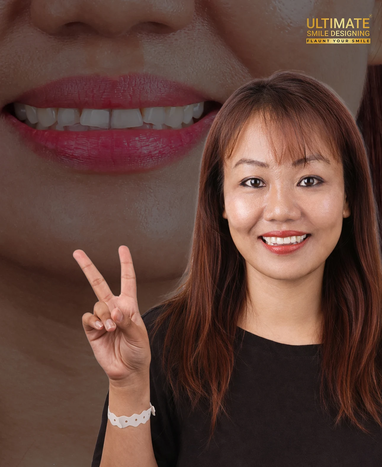 Ultimate smile design transformation before and after