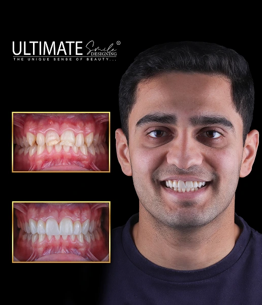 Dental veneers treatment before and after – enhanced smile aesthetics