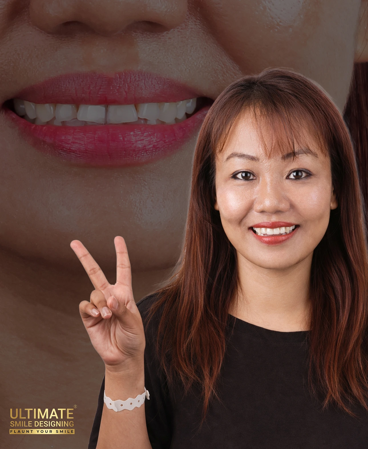 Ultimate smile design transformation before and after