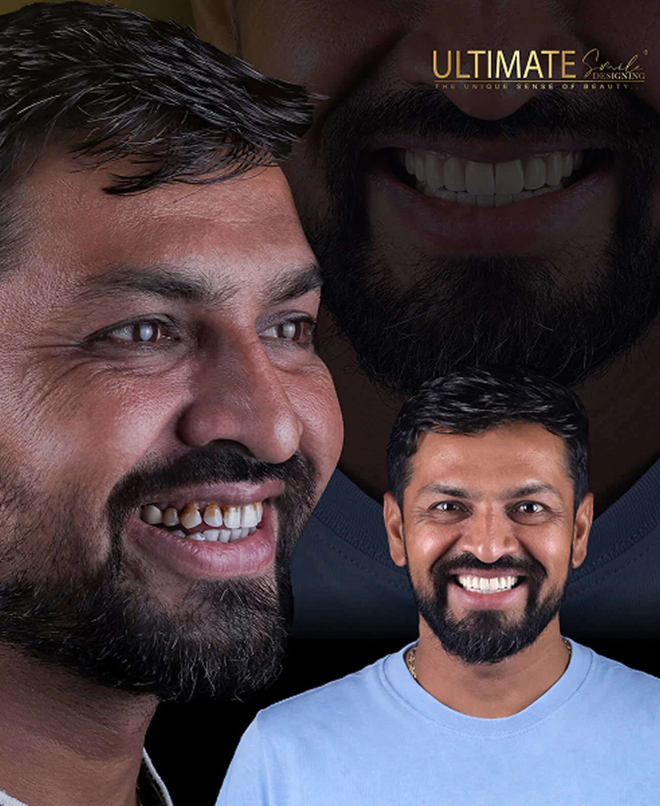 Ultimate Smile Design Before After Image Showcasing Best Smile Design Result
