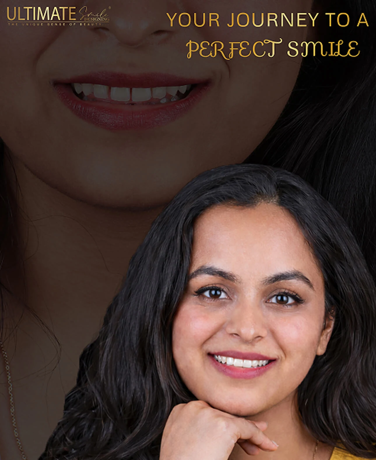 Smile design before and after results – improved tooth alignment