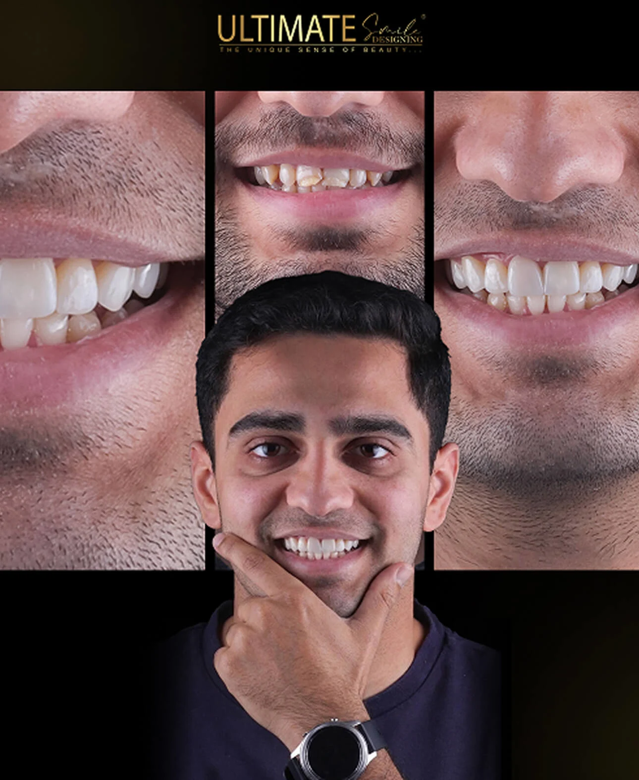 Dental veneers treatment before and after – enhanced smile aesthetics