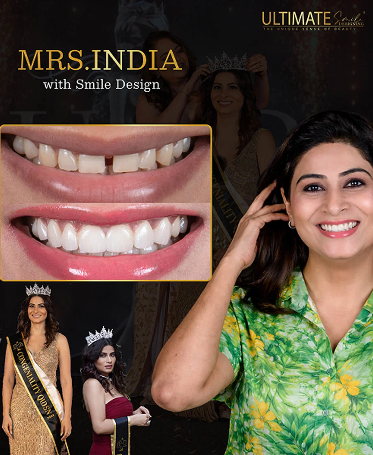 Cosmetic dentistry smile makeover comparison – teeth whitening and reshaping