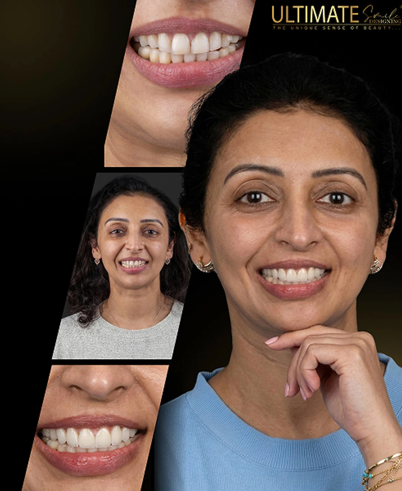 Smile design before after Image - Patient smile transformation