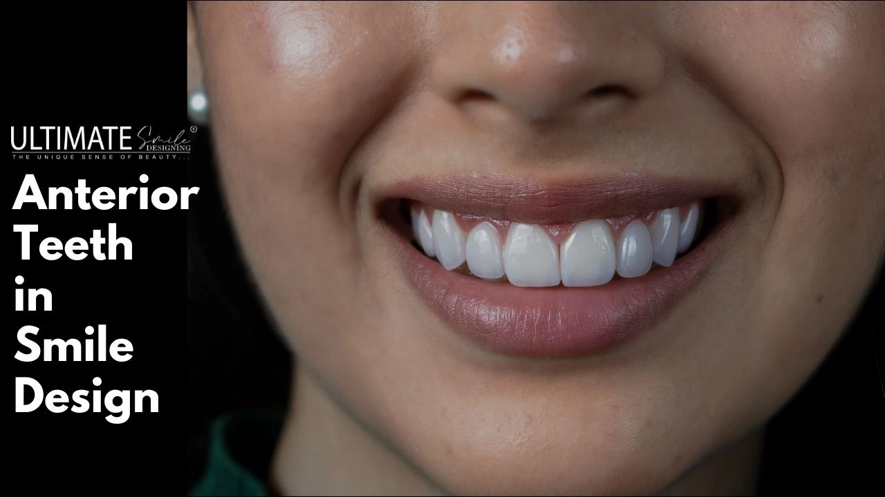 Best Restoration for Anterior (Front) Teeth Smile Design