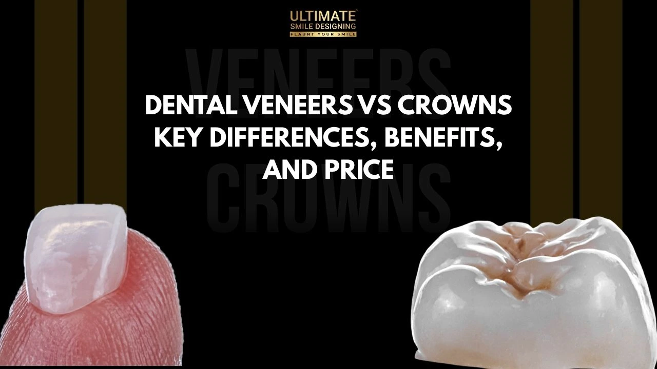 Dental Veneers Vs Crowns: Key Differences, Benefits, and Price