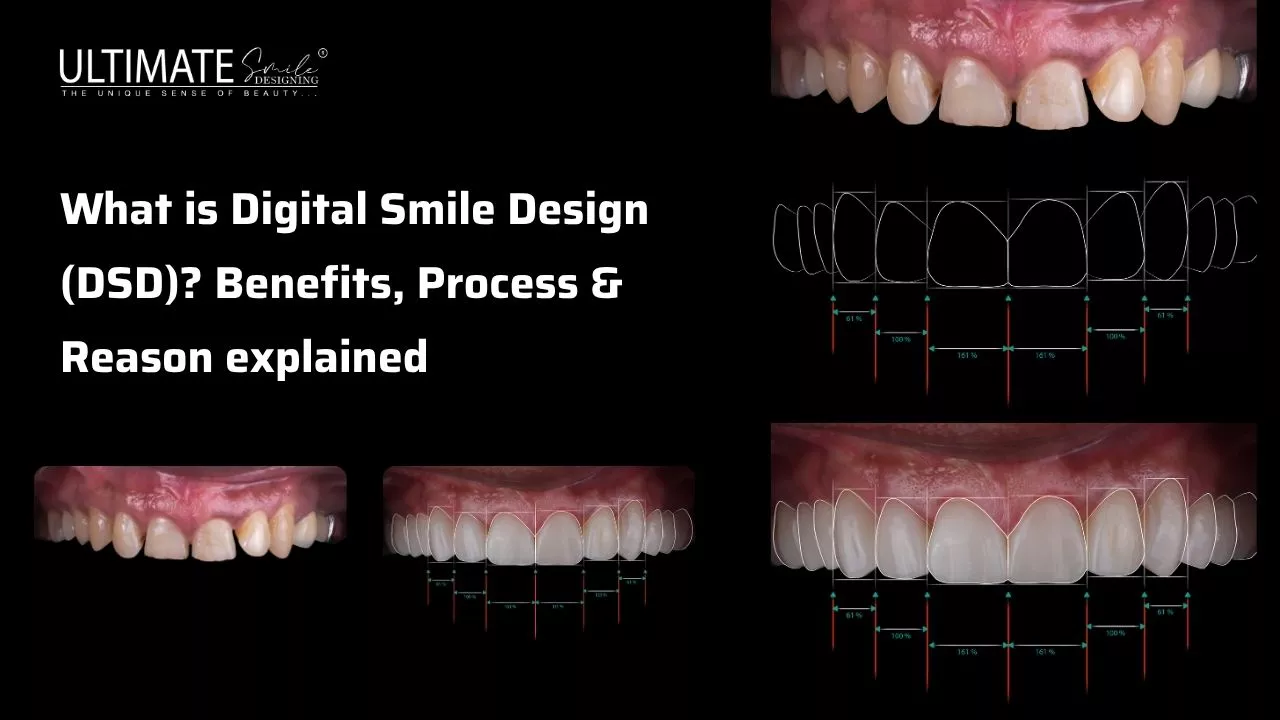 What is Digital Smile Design (DSD)? Benefits, Process & Reason explained