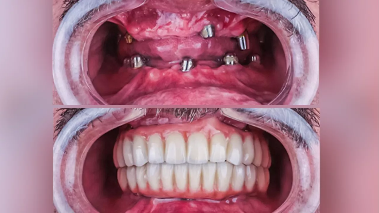 Top 5 Reasons to Choose Dental Implants for a Complete Smile Restoration