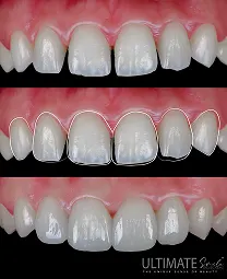 Authentic smile evolution captured in patient showcase at Ultimate Smile Design
