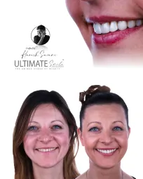 Patient journey from consultation to perfect smile in Ultimate Smile Design series