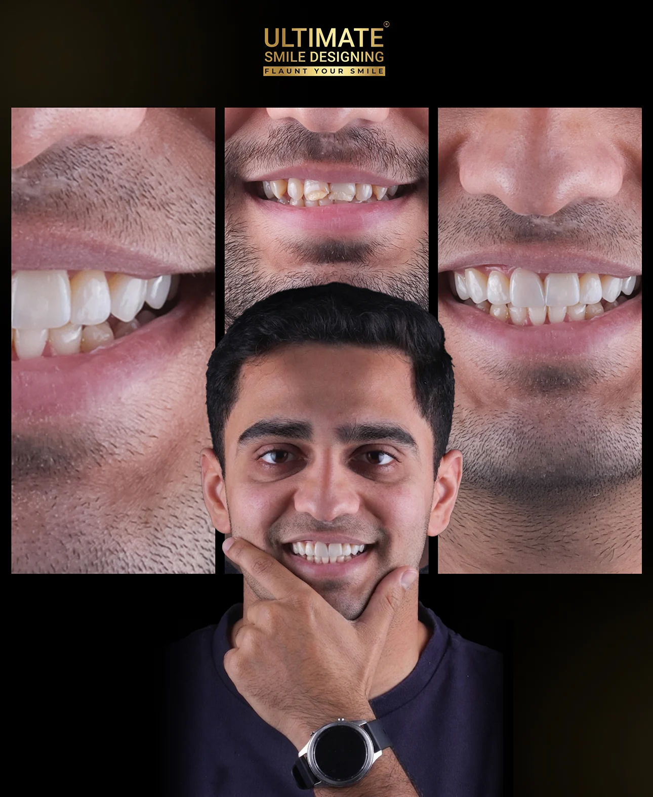 Before and after Ultimate Smile SDsign treatment of a real patient