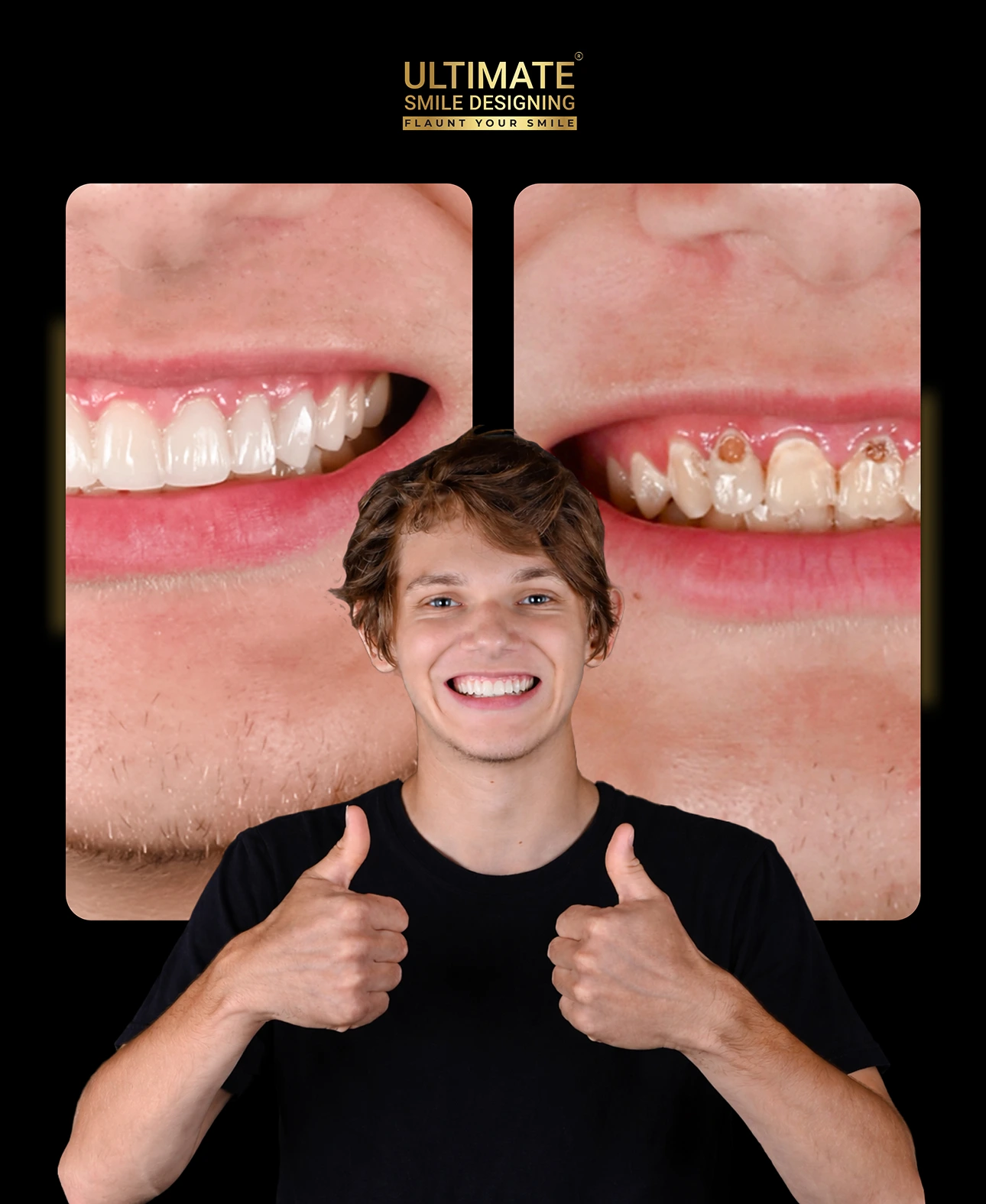 Before and after Ultimate Smile Design preview displaying a natural teeth transformation