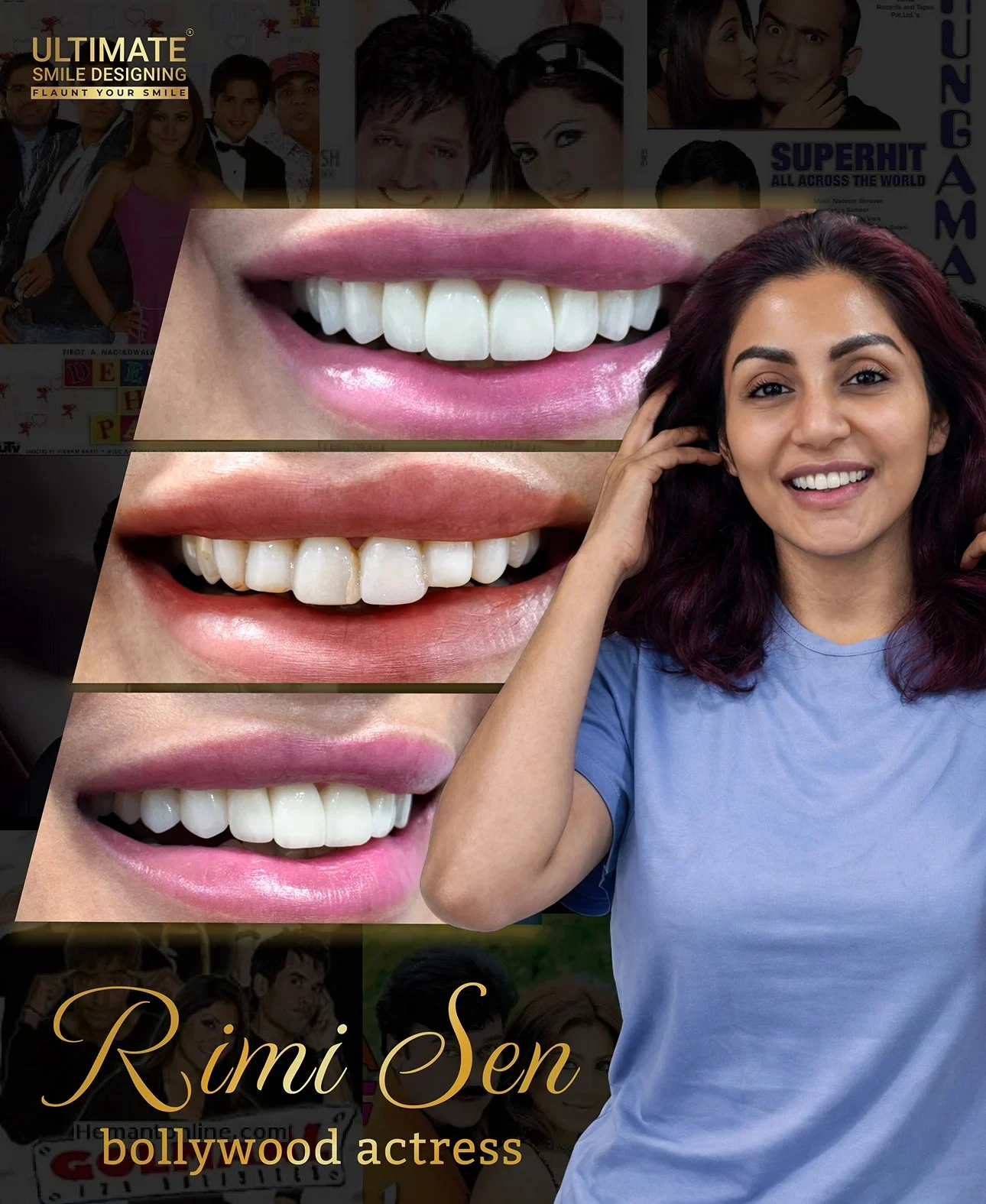 Aesthetic smile correction before and after result of Ultimate Smile Design