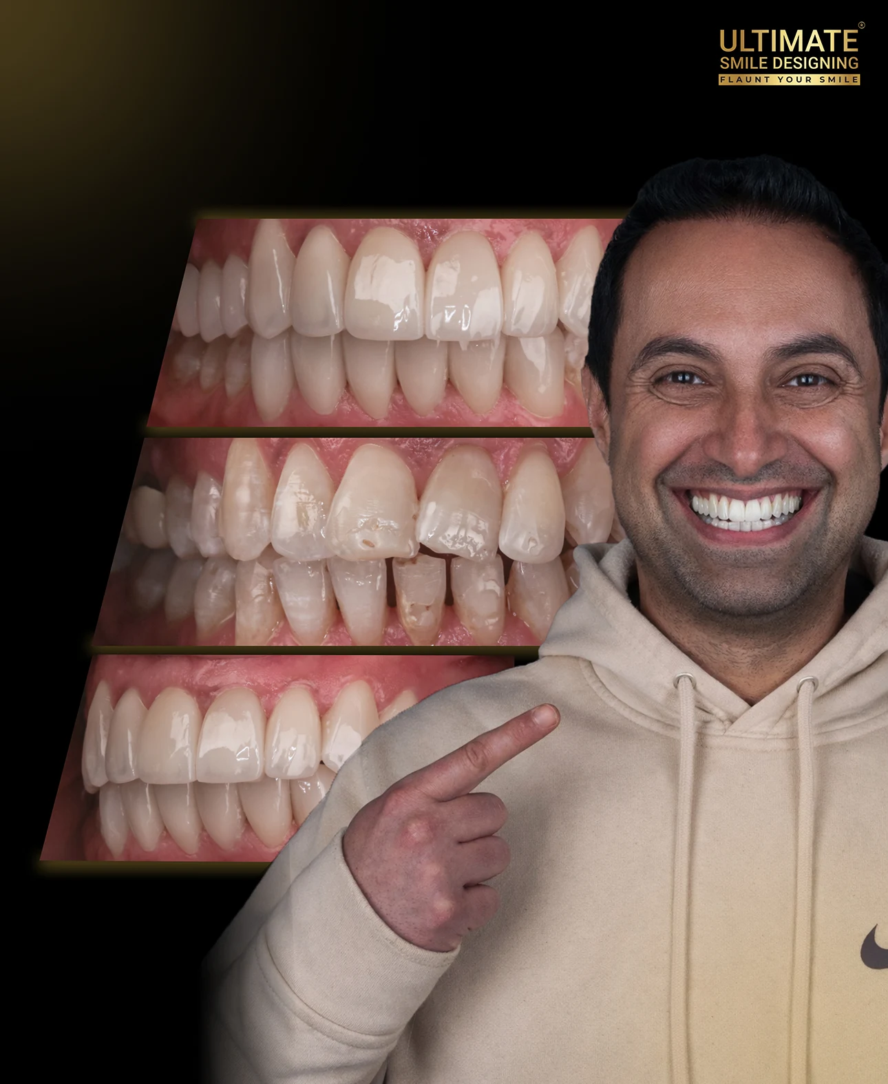 Digital smile transformation before and after case of a satisfied dental patient by Ultimate Smile Design