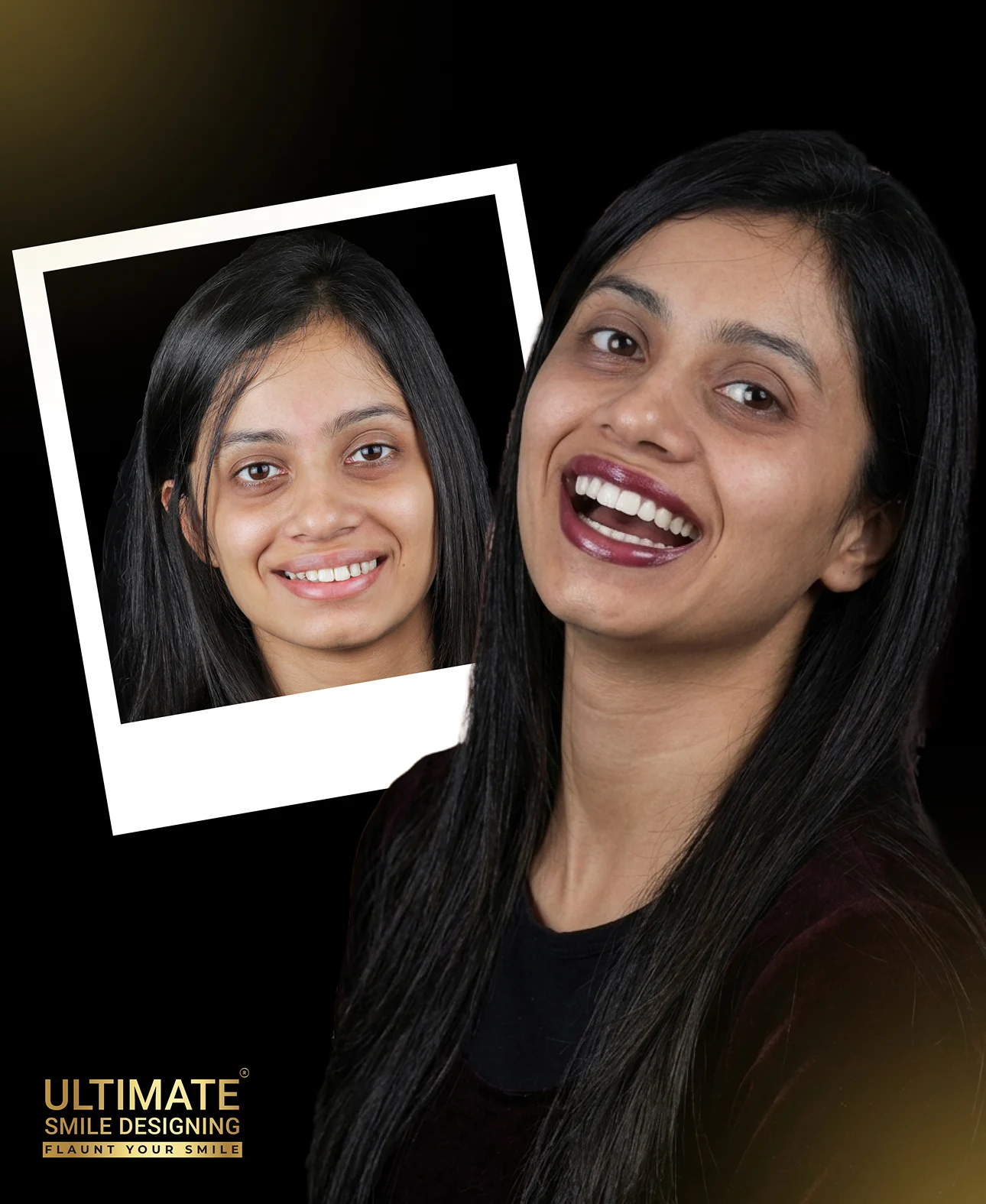 Successful Ultimate Smile Design before and after transformation by certified smile designer dentist