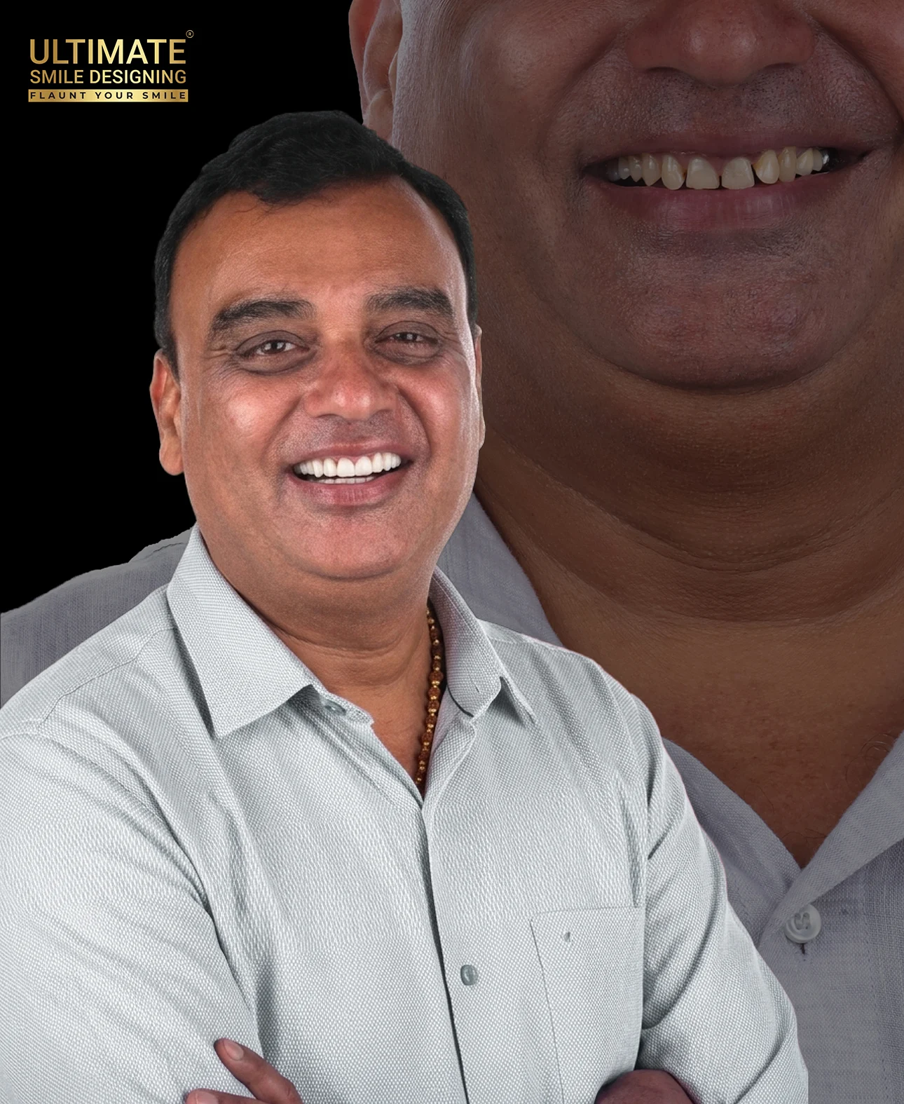 Smile design before-after image featuring real patient results of Ultimate Smile Design
